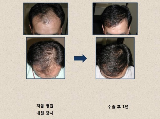 NSP통신-▲모발이식 수술 전후<사진제공=모리치피부과>