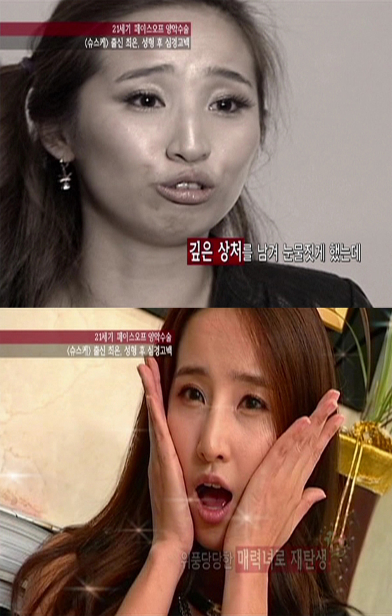 NSP통신-▲사진 위와 아래는 최은의 수술전과 후의 모습<사진= tvN 이뉴스 캡쳐>
