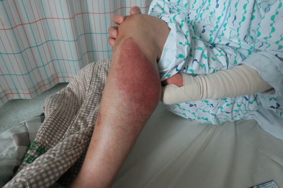 NSP통신-화재진압 유공자인 양태석씨의 왼쪽 팔과 다리의 부상 상태. (광명소방서)