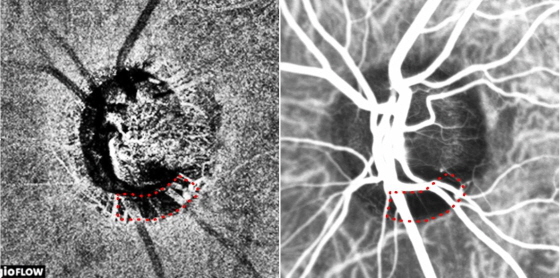 NSP통신-빛간섭단층 혈관조영검사(왼쪽) 및 인도시아닌그린 혈관조영검사로 얻은 녹내장 환자의 시신경유두 이미지. (분당서울대병원)