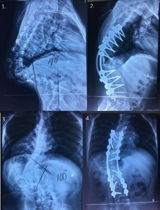 NSP통신-선천성 측만증과 후만증으로 심한 곱추병을 앓던 환아의 수술전후 x-ray 사진. (분당서울대병원)