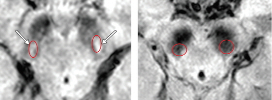 NSP통신-(왼쪽부터)정상 렘수면행동장애환자 뇌 MRI 이미지, 파킨슨병이 예견되는 렘수면행동장애환자 뇌 MRI 이미지. (분당서울대병원)