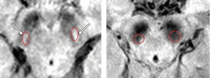 [NSP PHOTO]분당서울대병원, MRI검사 통해 파킨슨병 진행 예측