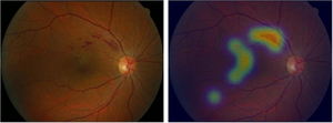 [NSP PHOTO]분당서울대병원, 눈 건강 이상 판독 딥러닝 알고리즘 개발
