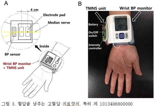 NSP통신-특허 제1013496800000 혈압을 낮추는 고혈압 치료장치.