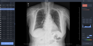[NSP PHOTO]대구파티마병원, 인공지능 기반 미래형 의료기기 뷰노메드 체스트 x-ray 도입