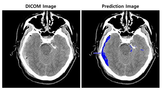 NSP통신-뇌출혈이 의심되는 환자의 뇌 CT 영상(좌)과 뇌출혈 영상 판독 AI모델이 출혈 병변(화살표) 존재와 위치를 식별한 영상. (SK㈜ C&C)