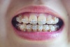 [NSP PHOTO][들어보니] 부정교합 소아·청소년 치아교정 통한 골격 형성 매우 중요