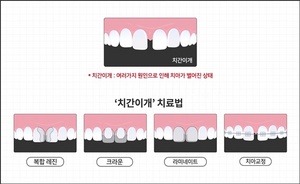 [NSP NEWS Image]앞니 벌어진 치간이개 원인과 치료법은