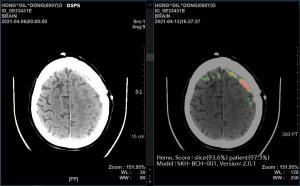[NSP PHOTO]SK C&C AI 뇌출혈 영상 의료 솔루션 효과 글로벌 논문 게재
