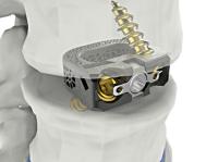 [NSP PHOTO]시지메드텍, 경추·요추 케이지 라인업 완성…척추 융합기기 유니스페이스 FDA 승인