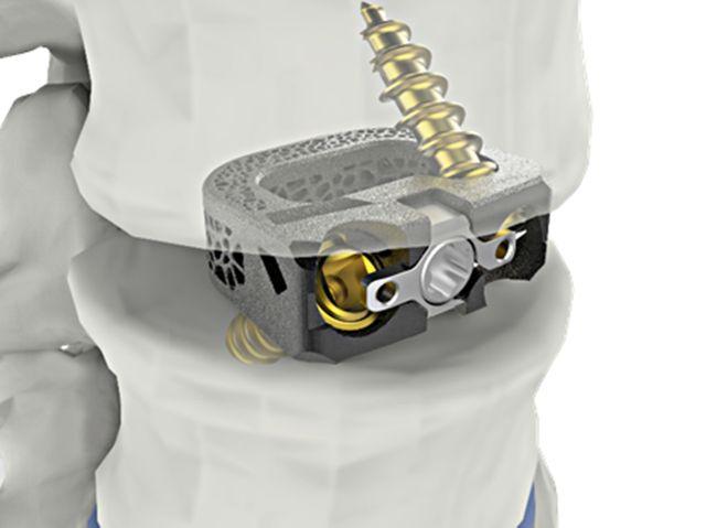 NSP통신-미국 FDA로 부터 승인 받은 시지메드텍의 유니스페이스(UniSpace TPLIF Cage, 요추 케이지). (이미지 = 대웅)